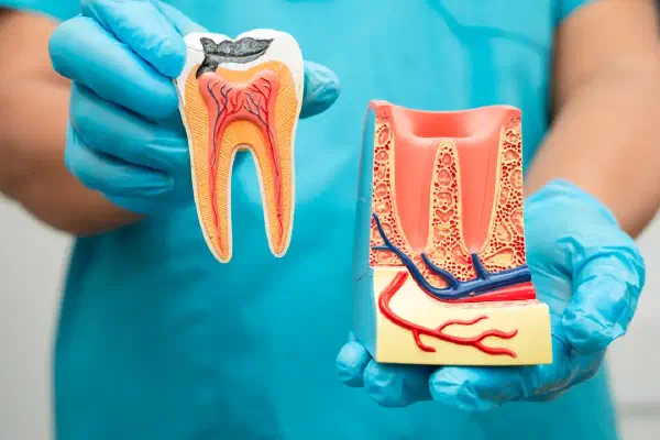 Tooth Decay: Expert Care in Del Rey Oaks & Monterey