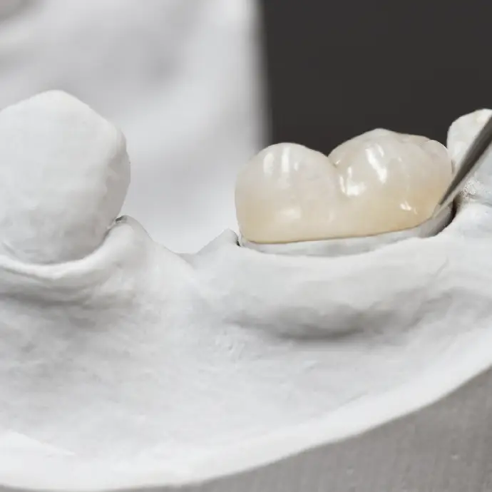 Selection of different dental crown materials