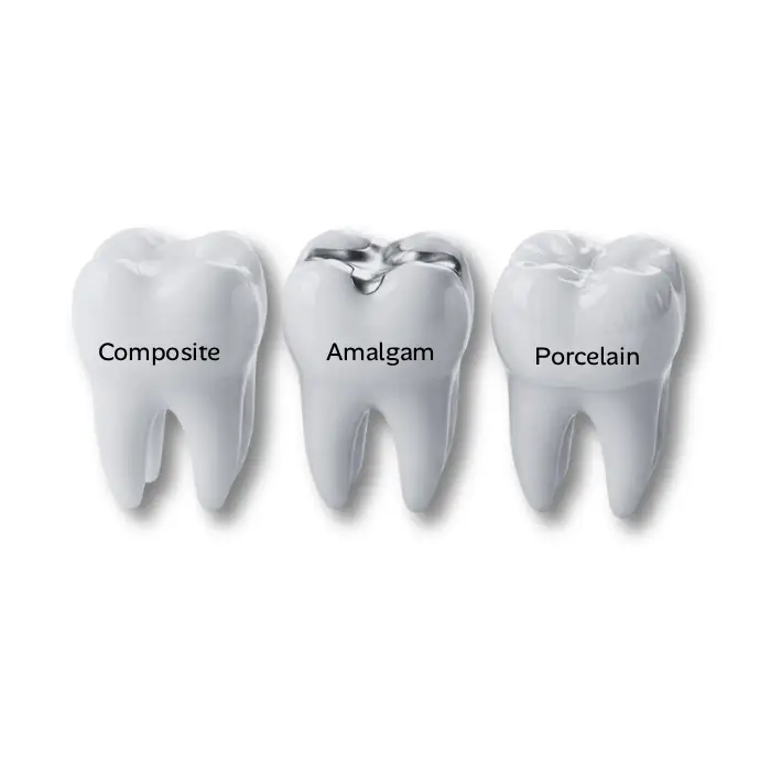 Comparison of different dental filling materials