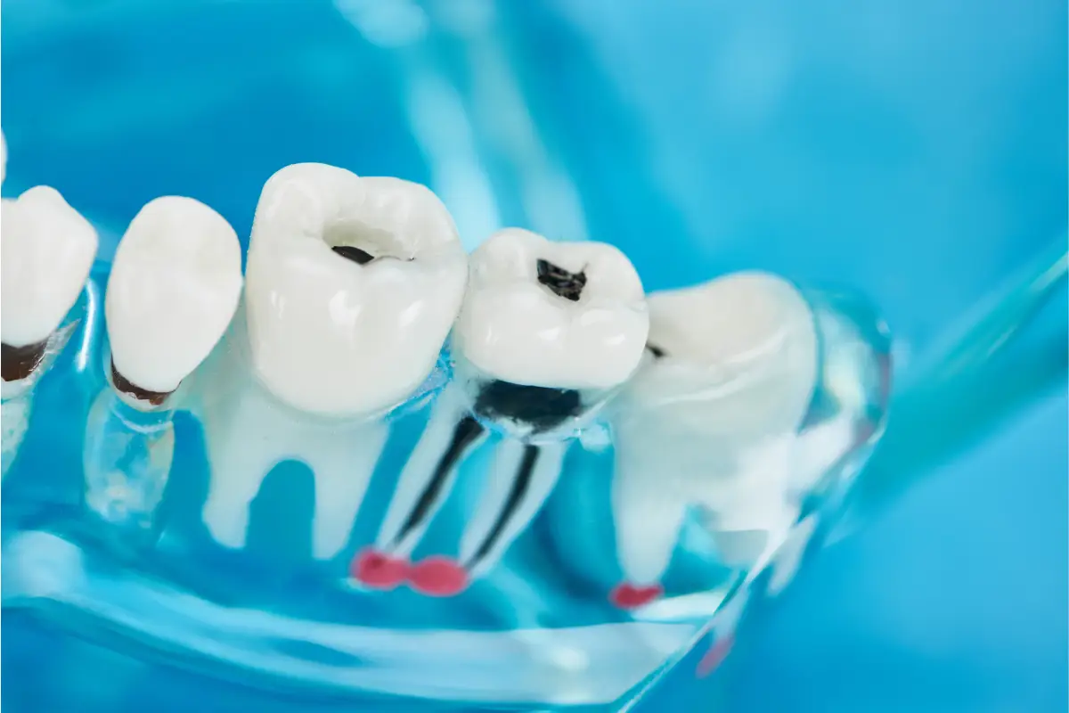 Dental Fillings Near Me: Expert Care in Del Rey Oaks