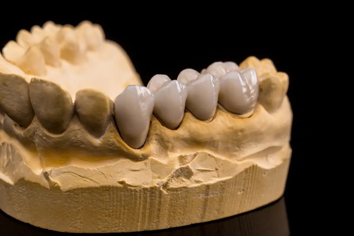 dental bridge model