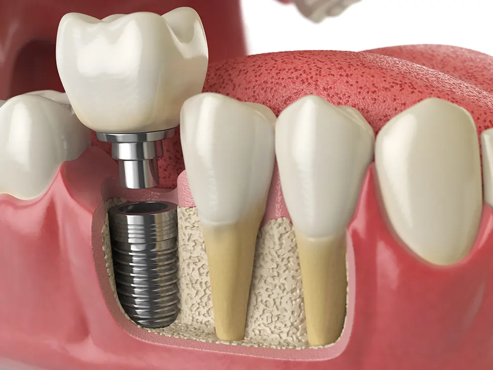 Expert Dental Implants in Monterey & Del Rey Oaks, CA