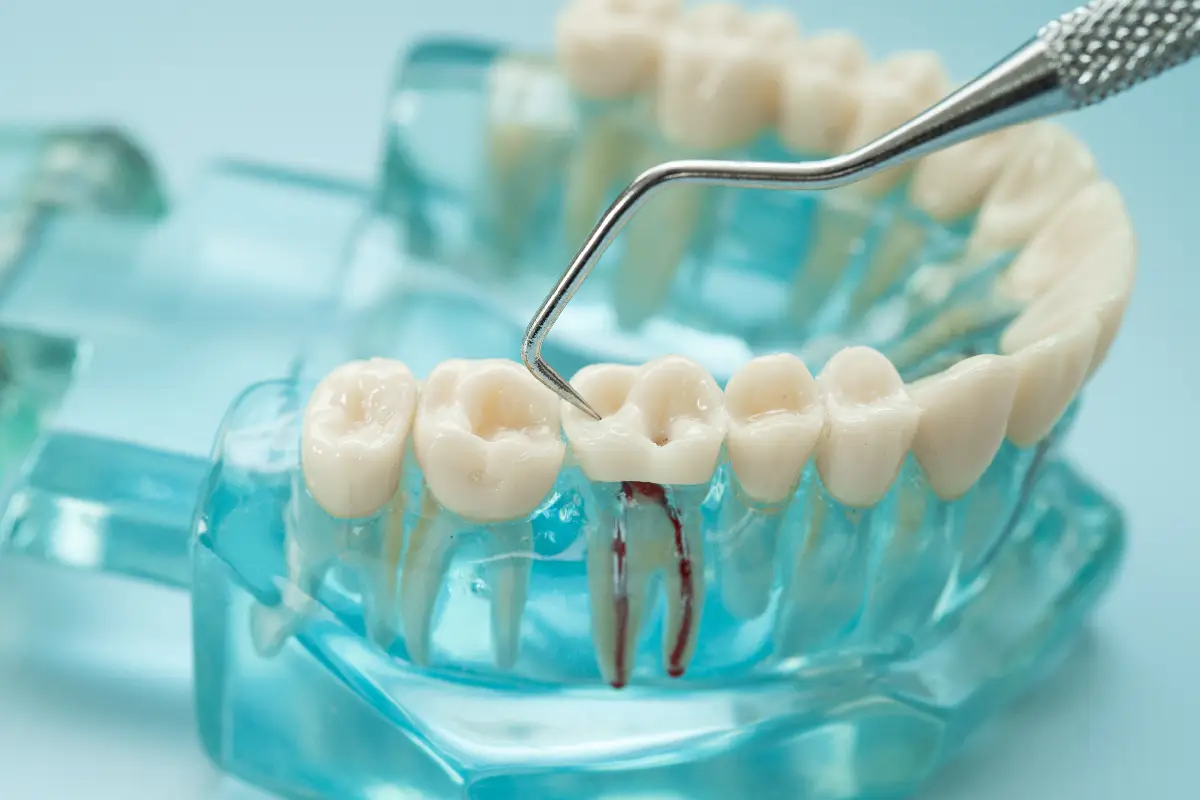 Cavity Fillings: Answers, Care, and Relief | Del Rey Oaks