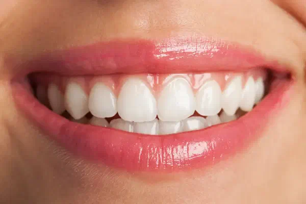 Teeth Whitening vs. Veneers: Should You Whiten Your Teeth Before Getting Veneers?